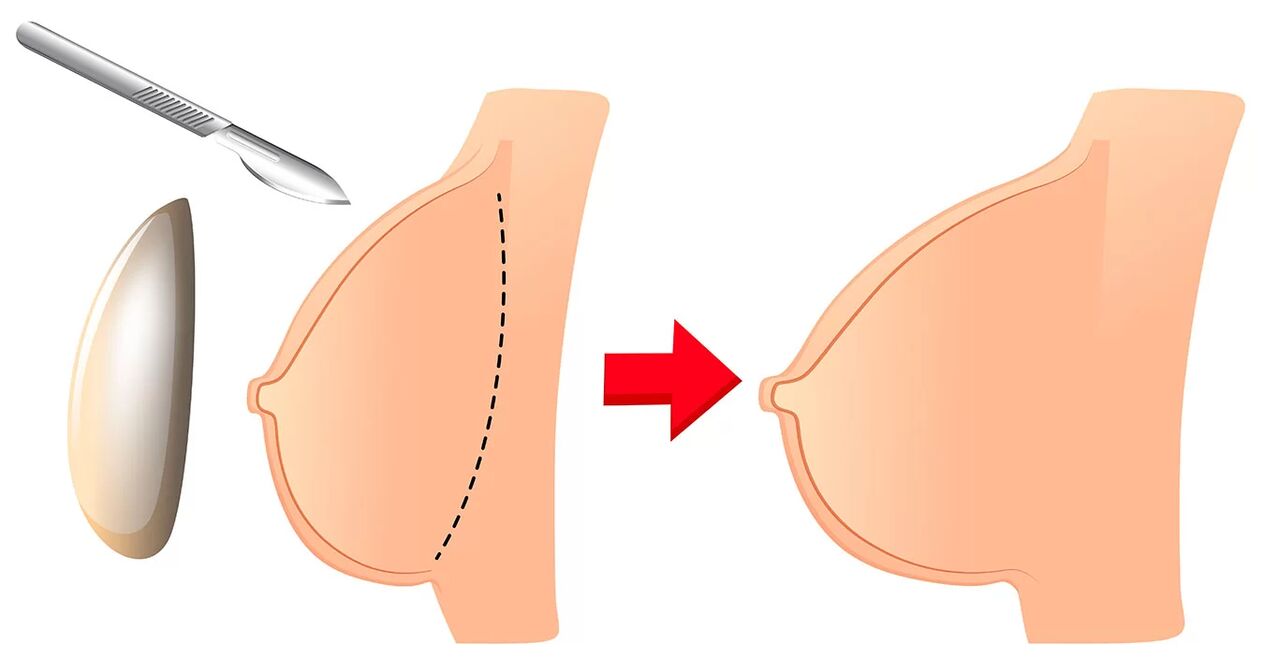Ingrandimento del seno con una protesi